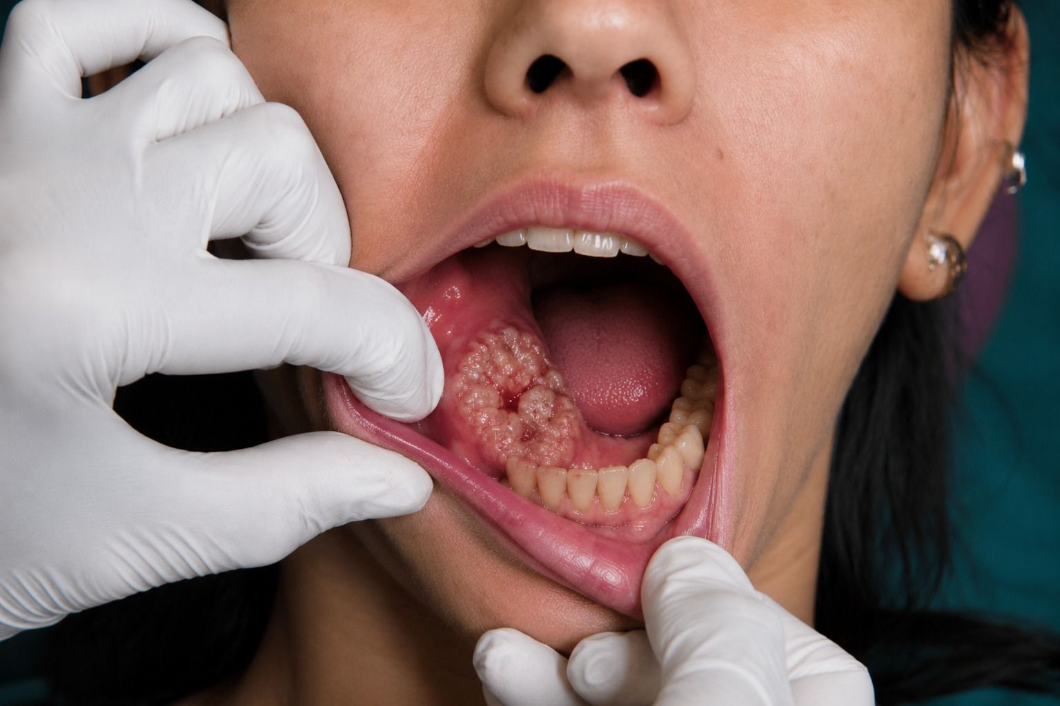 Maxillofacial & Oral Oncology